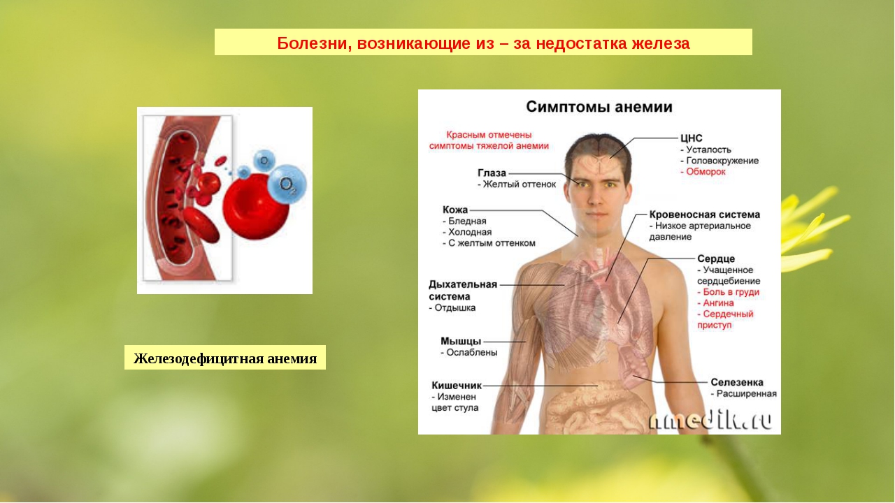 К анемии может привести недостаток. Дефицит железа заболевания. Заболевания при дефиците железа. Заболевания при анемии. Недостаток железа в организме.