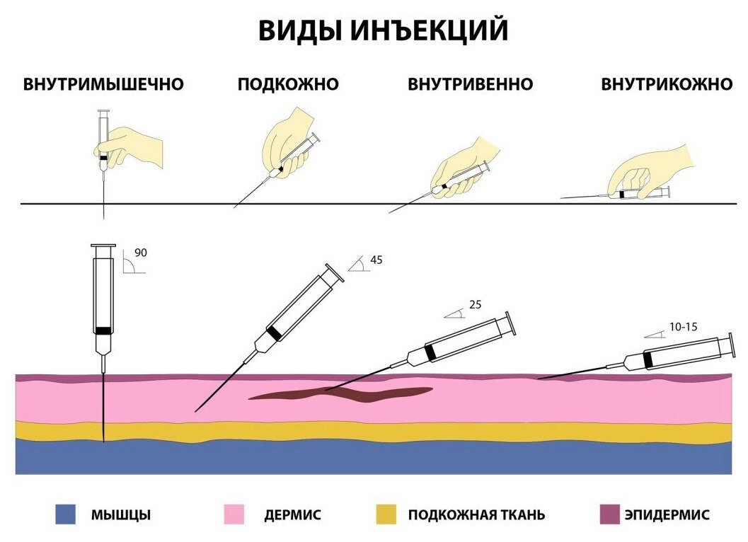 Отметьте на рисунке и напишите места для внутримышечных инъекций